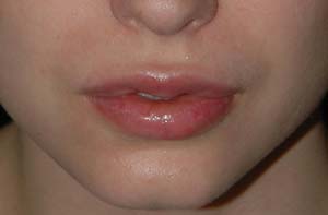 Lip Augmentation - Patient 3 - After